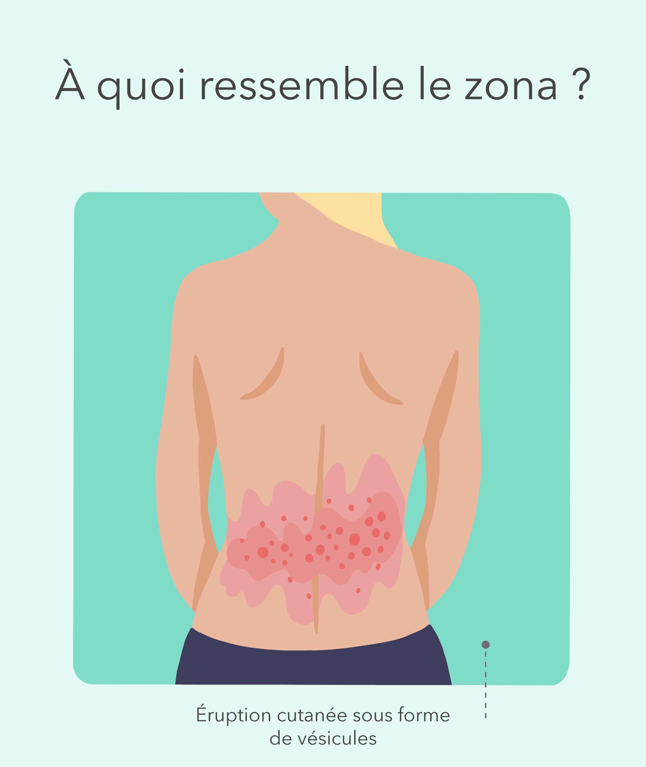 Zona Qu Est Ce Que Le Zona Sympt Mes Et Traitement Redcare Pharmacie