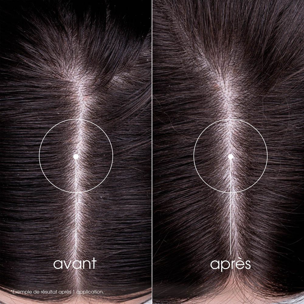 Vue du cuir chevelu avant et après. Cercle. Texte: avant, après.