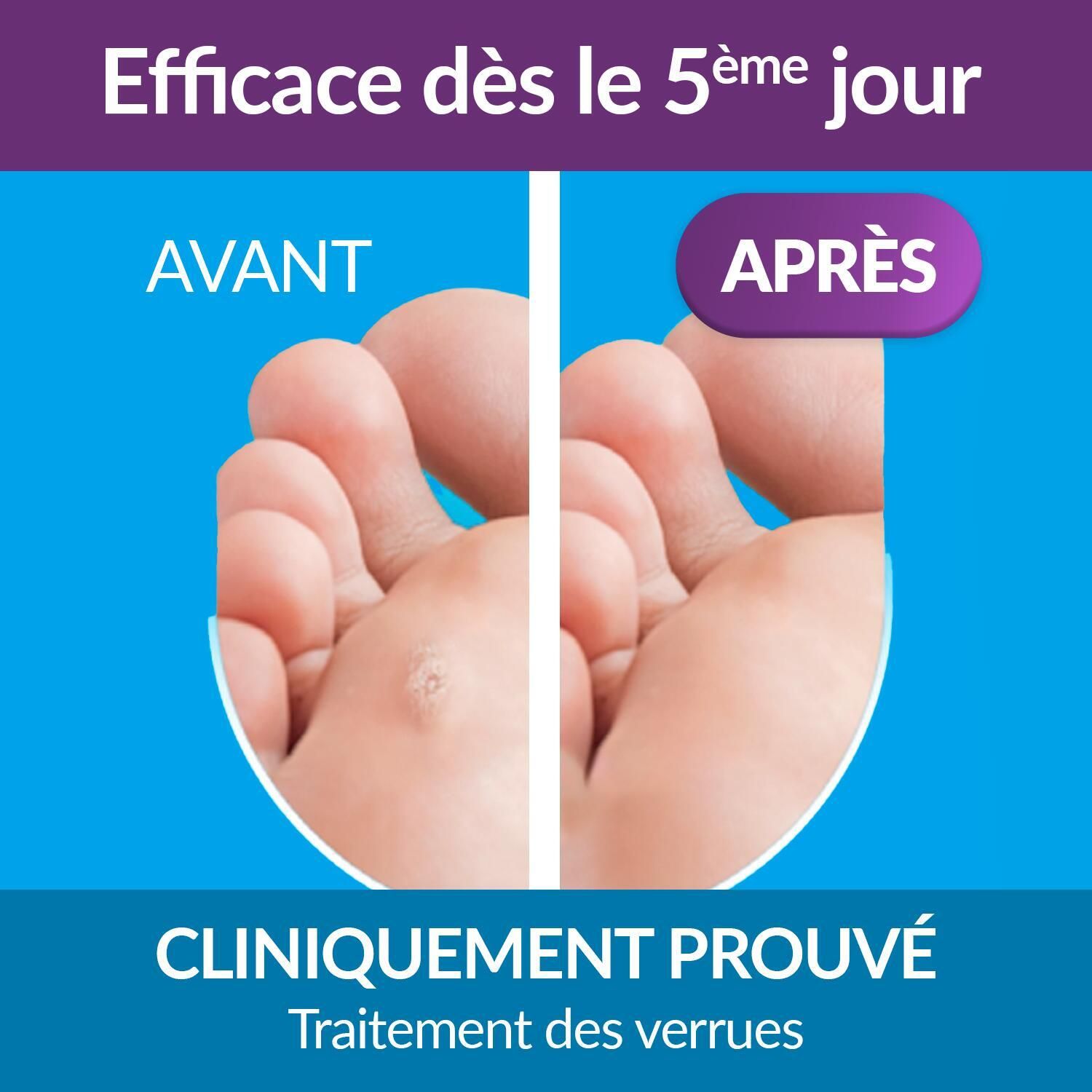 Image avant-après d'un pied. Montre l'élimination d'une verrue. Texte : Cliniquement prouvé.