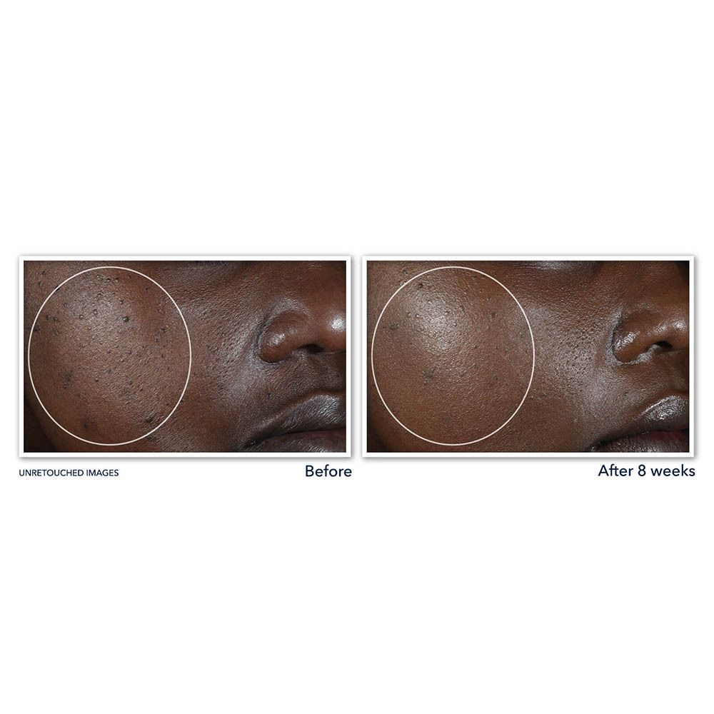 Comparaison avant-après d'images de peau. Cercles mettent en évidence des zones. Texte : Images non retouchées.