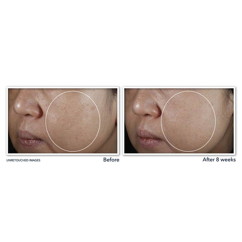 Comparaison avant-après d'images de peau. Cercles mettent en évidence des zones. Texte : Images non retouchées.