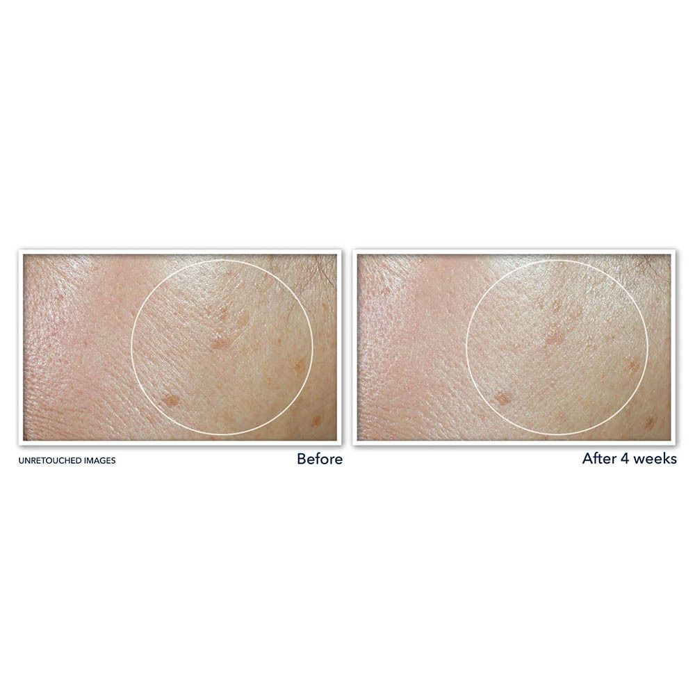 Comparaison avant-après. Zones de peau. Produit : Roc Multi Correxion.
