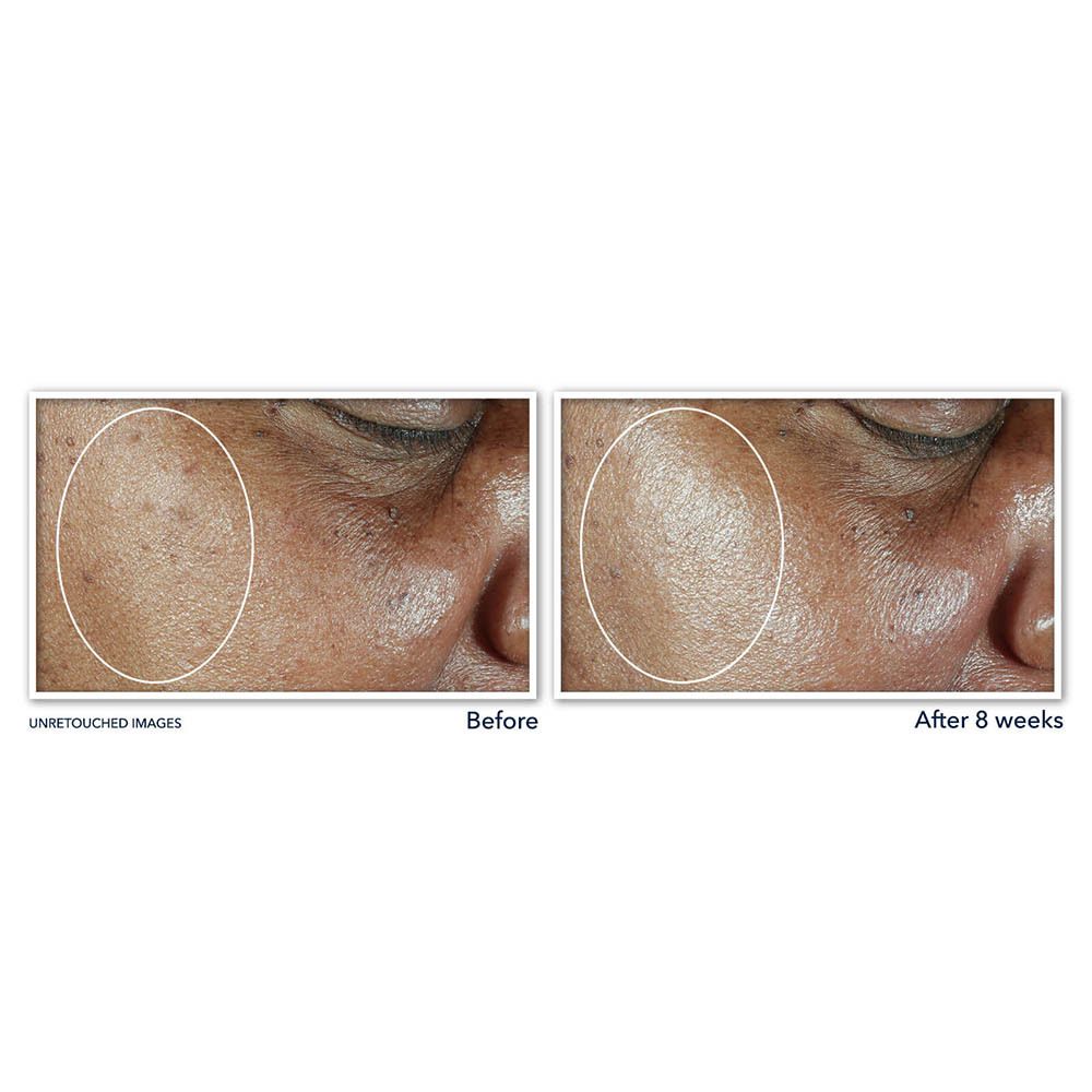 Comparaison avant-après. Zones de peau. Produit : Roc Multi Correxion.