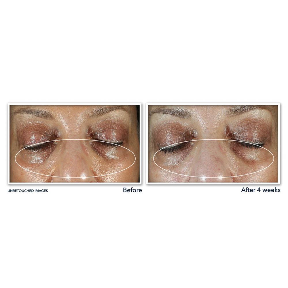 Images avant-après des yeux. Comparaison après 4 semaines. RoC Multi Correxion.