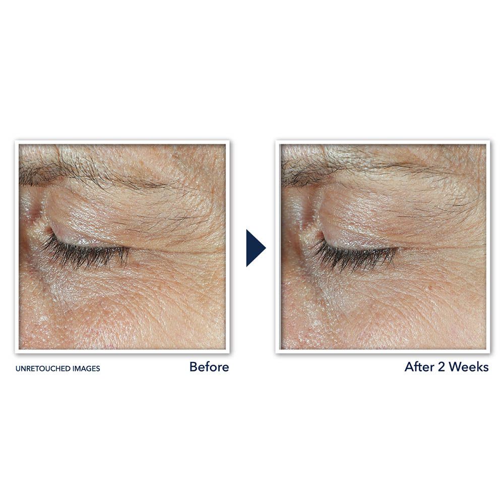 Image avant-après. Contour des yeux avant et après 2 semaines. Réduction des rides visible.