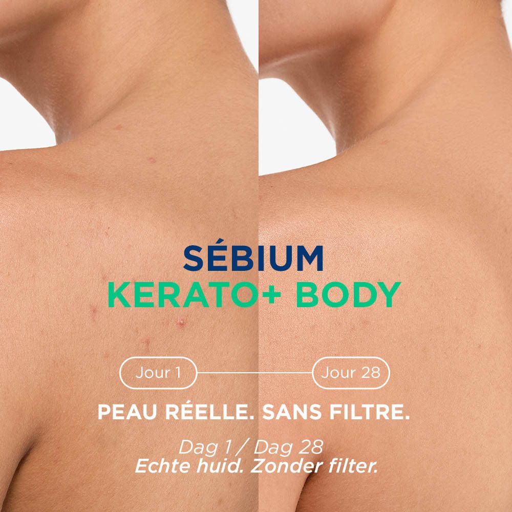 Comparaison avant/après 28 jours. Texte: Sébium Kerato+ Body. Peau réelle. Sans filtre.