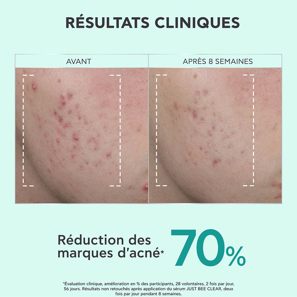 Gros plan sur la peau. Texte : Avant/Après. Réduction des imperfections.