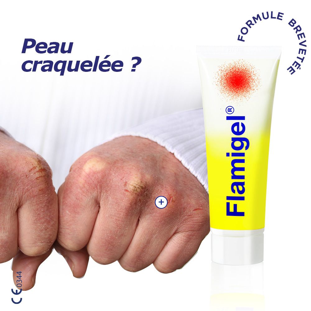 Tube Flamigel à côté de mains présentant une peau craquelée.