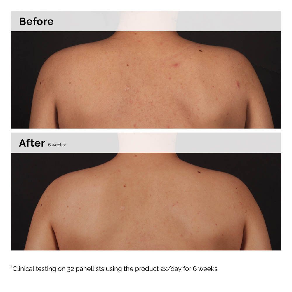 Comparaison avant/après : dos avec imperfections, puis peau améliorée après 6 semaines.