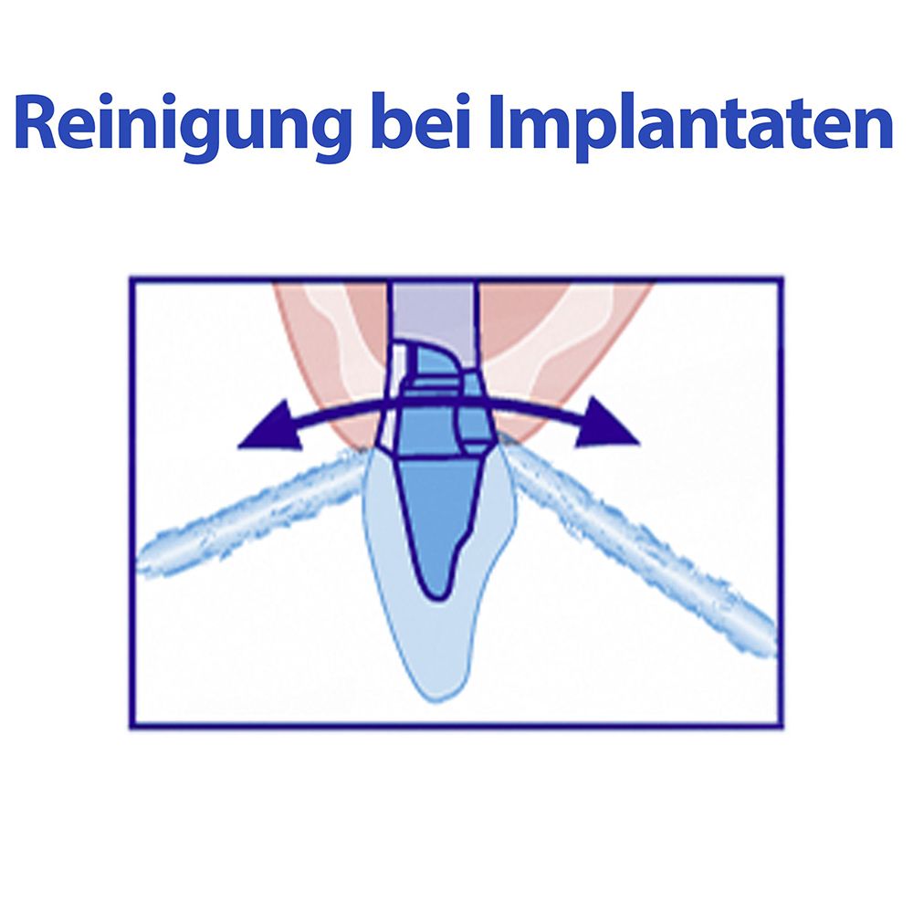 Illustration: Nettoyage sous implants. Flèches montrent le mouvement du fil autour de l'implant.