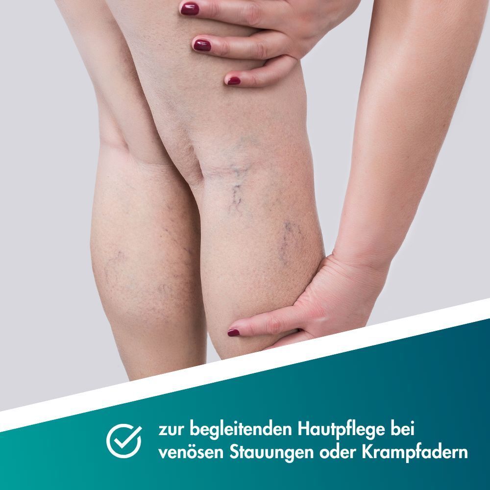 Jambes avec varices et varicosités, une main tient le genou.