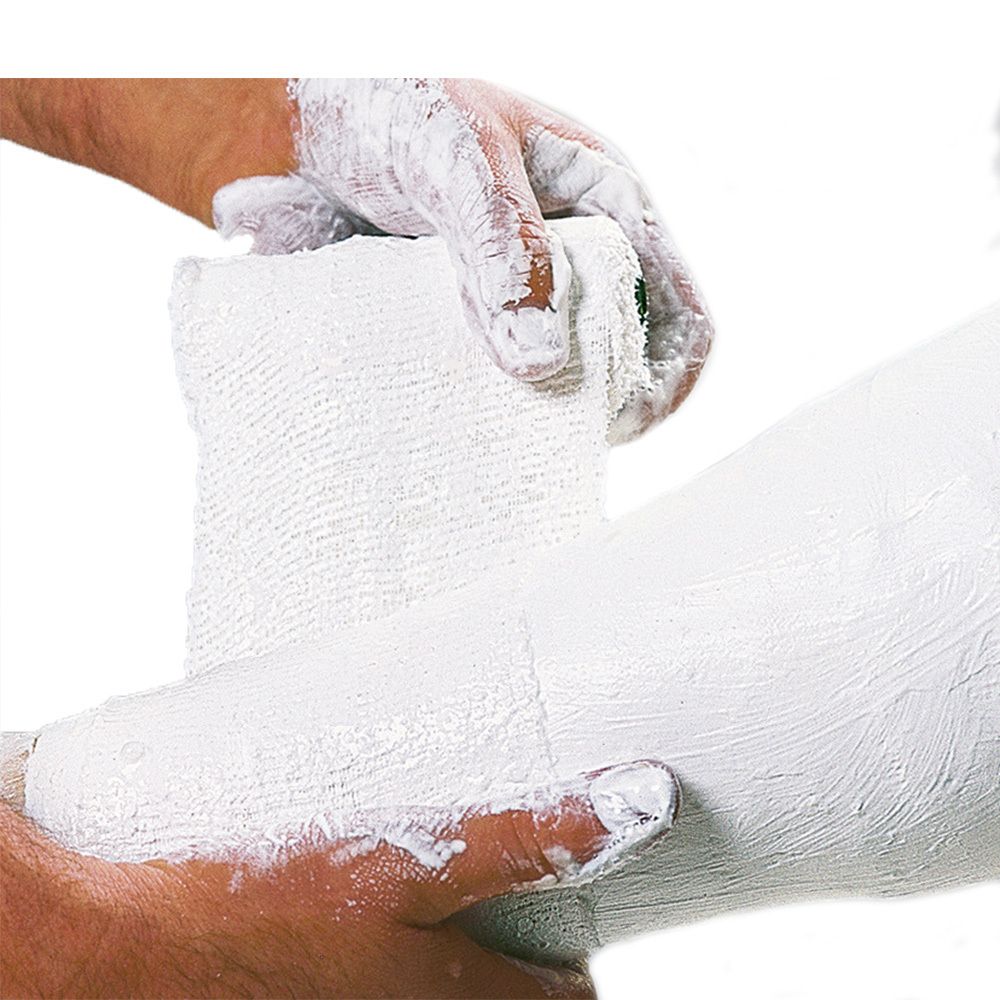 Application d'un bandage plâtré sur une jambe. Mains recouvertes de plâtre. Le bandage est enroulé.