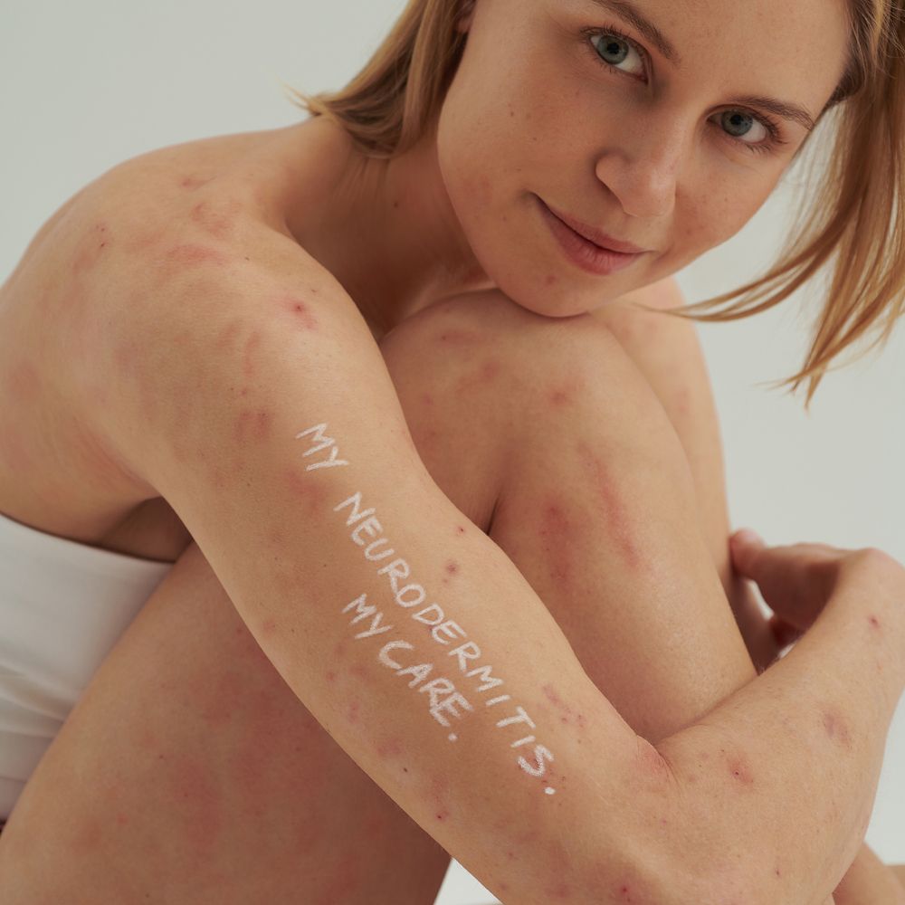 Femme avec éruptions cutanées. Sur le bras : MY NEURODERMITIS. MY CARE.