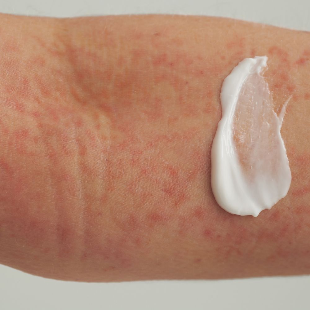 Bras avec rougeurs cutanées. Goutte de crème sur la peau. Crème blanche.