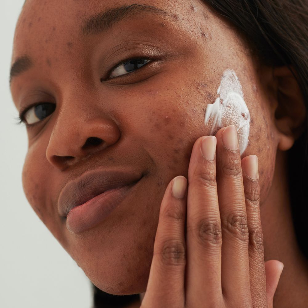 Personne appliquant de la crème sur le visage. Peau avec imperfections. Crème claire appliquée.
