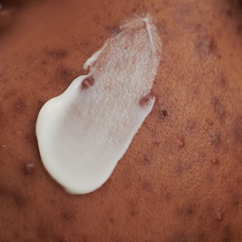 Gros plan de crème sur la peau. Crème blanche sur peau foncée. Imperfections cutanées visibles.