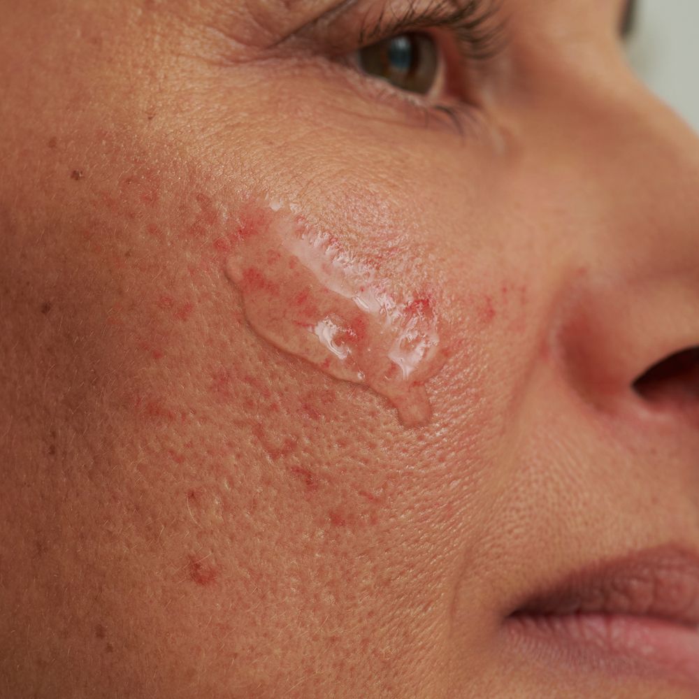Gros plan sur un visage avec une substance gélifiée transparente appliquée sur la peau. Rougeurs et imperfections visibles.