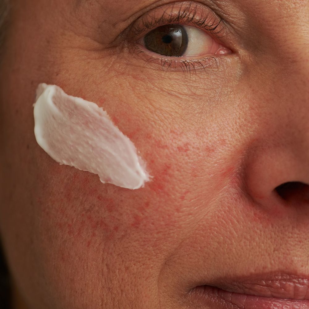 Peau avec crème blanche appliquée. Rougeurs visibles. Gros plan.