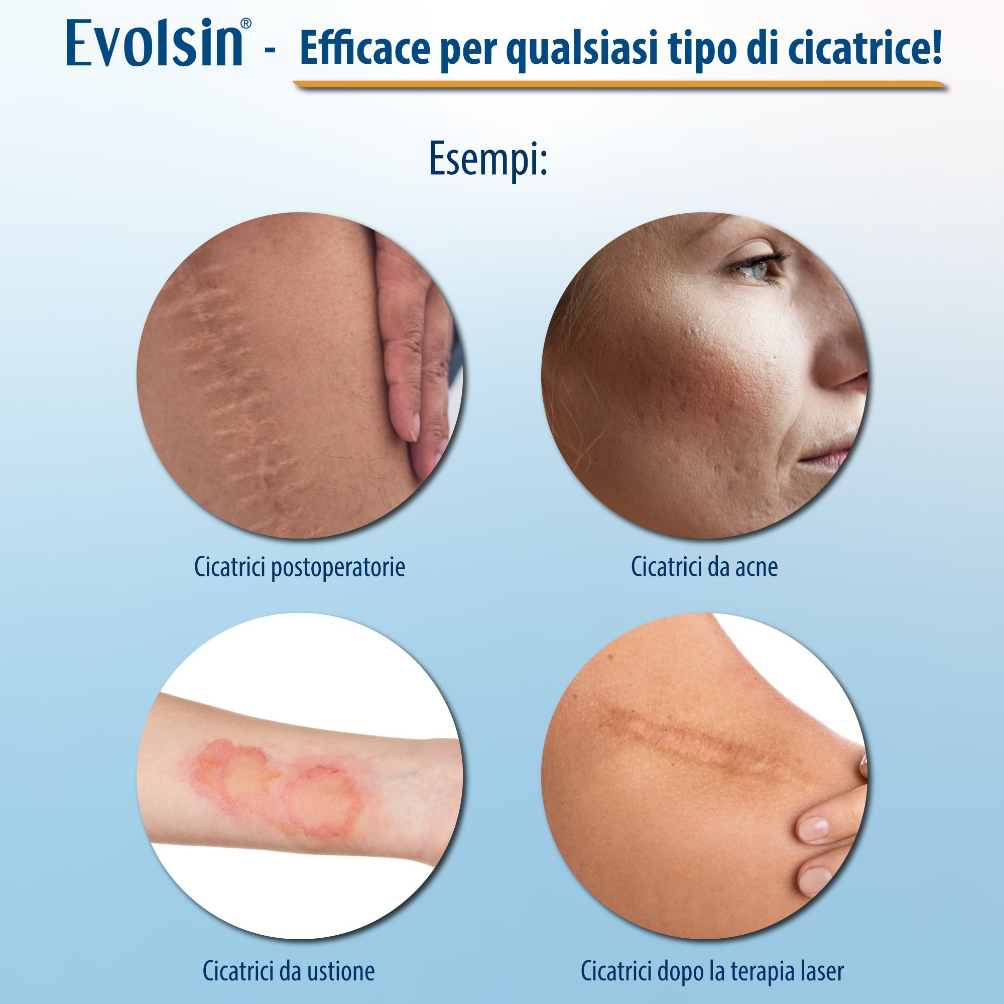 Exemples de cicatrices : cicatrices chirurgicales, cicatrices d'acné, cicatrices de brûlures et cicatrices après laser. Images circulaires.