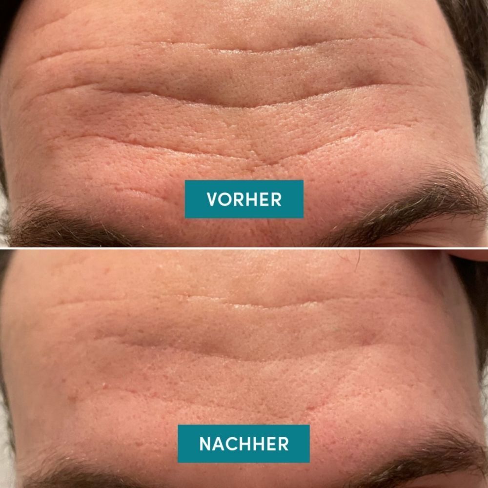 Comparaison avant-après des rides du front, avec et sans Patchs Visage APRICOT.