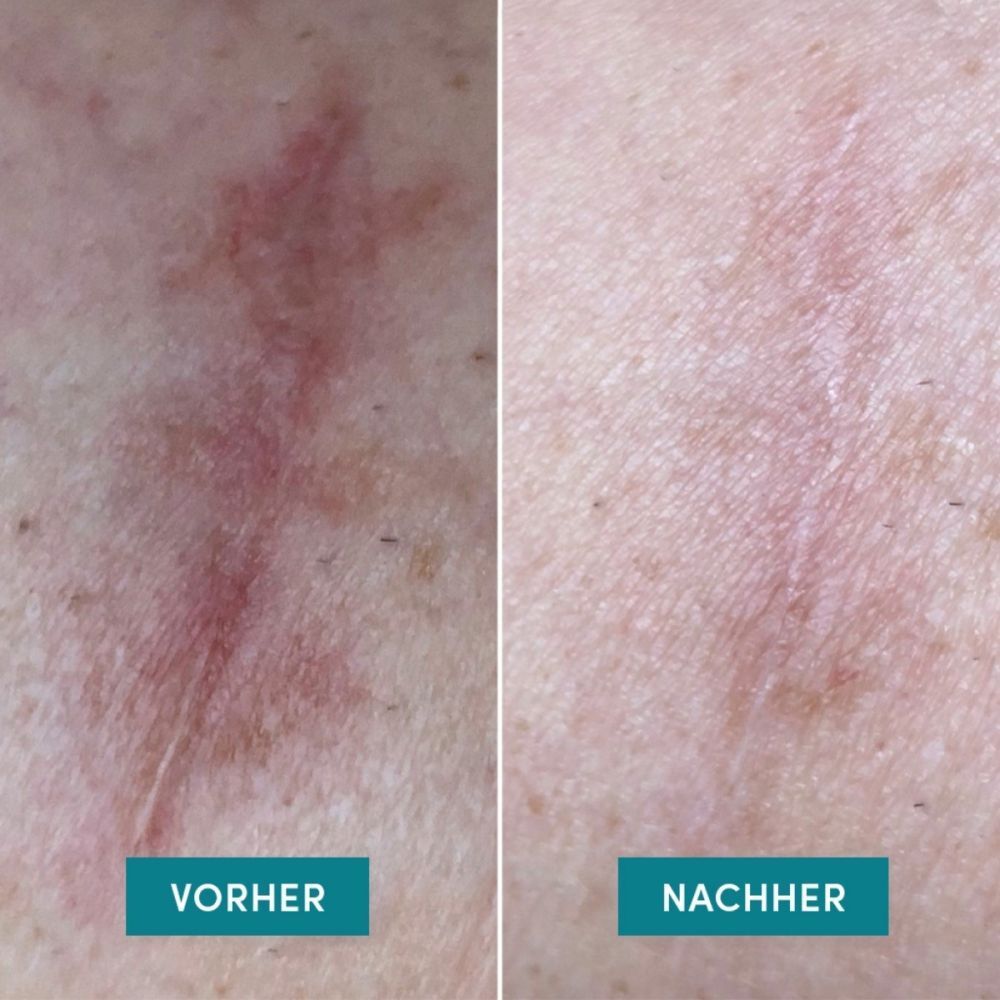 Deux gros plans : comparaison avant-après d'une cicatrice. Inscription : Avant, Après. Peau avec cicatrice.