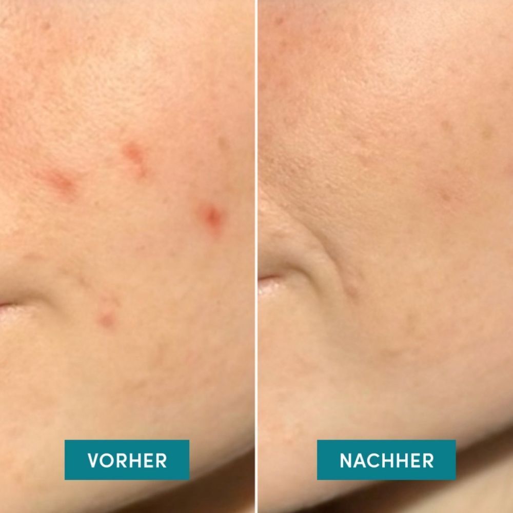 Image comparative : peau avec boutons (avant) et peau après traitement (après).