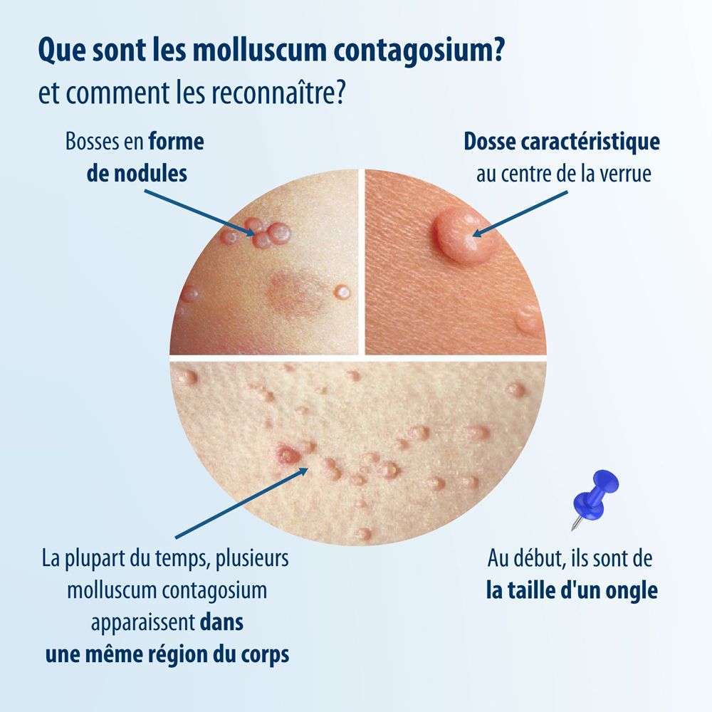 Molluscum contagiosum : lésions en forme de nodules, souvent en groupe.