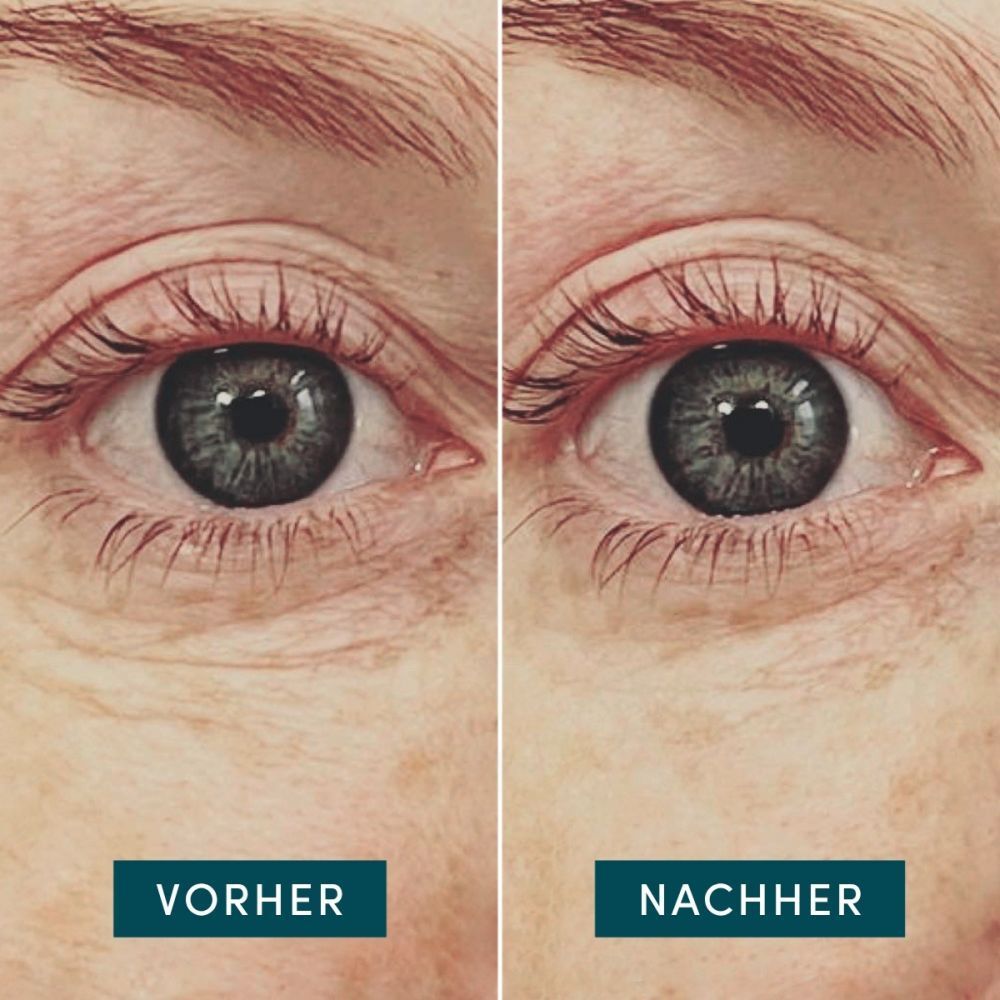 Comparaison avant-après des yeux. Gauche : Avant, droite : Après. Texte : Avant, Après.