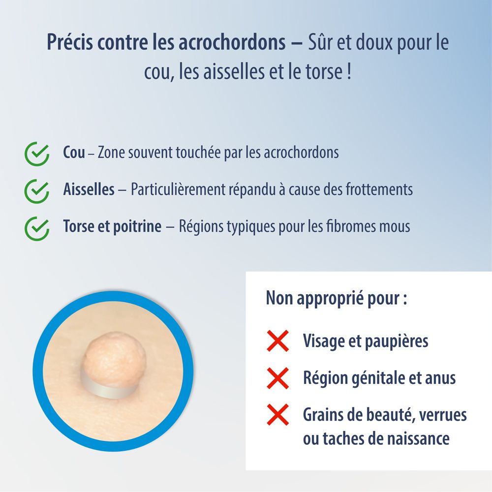 Un pansement pour traiter les acrochordons, montré sur la peau avec un acrochordon.