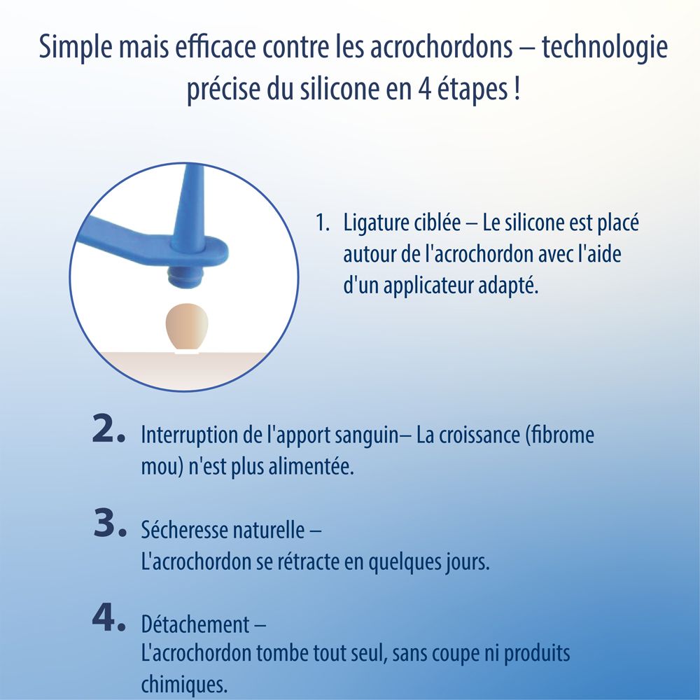 Dispositif bleu d'élimination des acrochordons avec applicateur et anneau en silicone, fonctionnant en 4 étapes.
