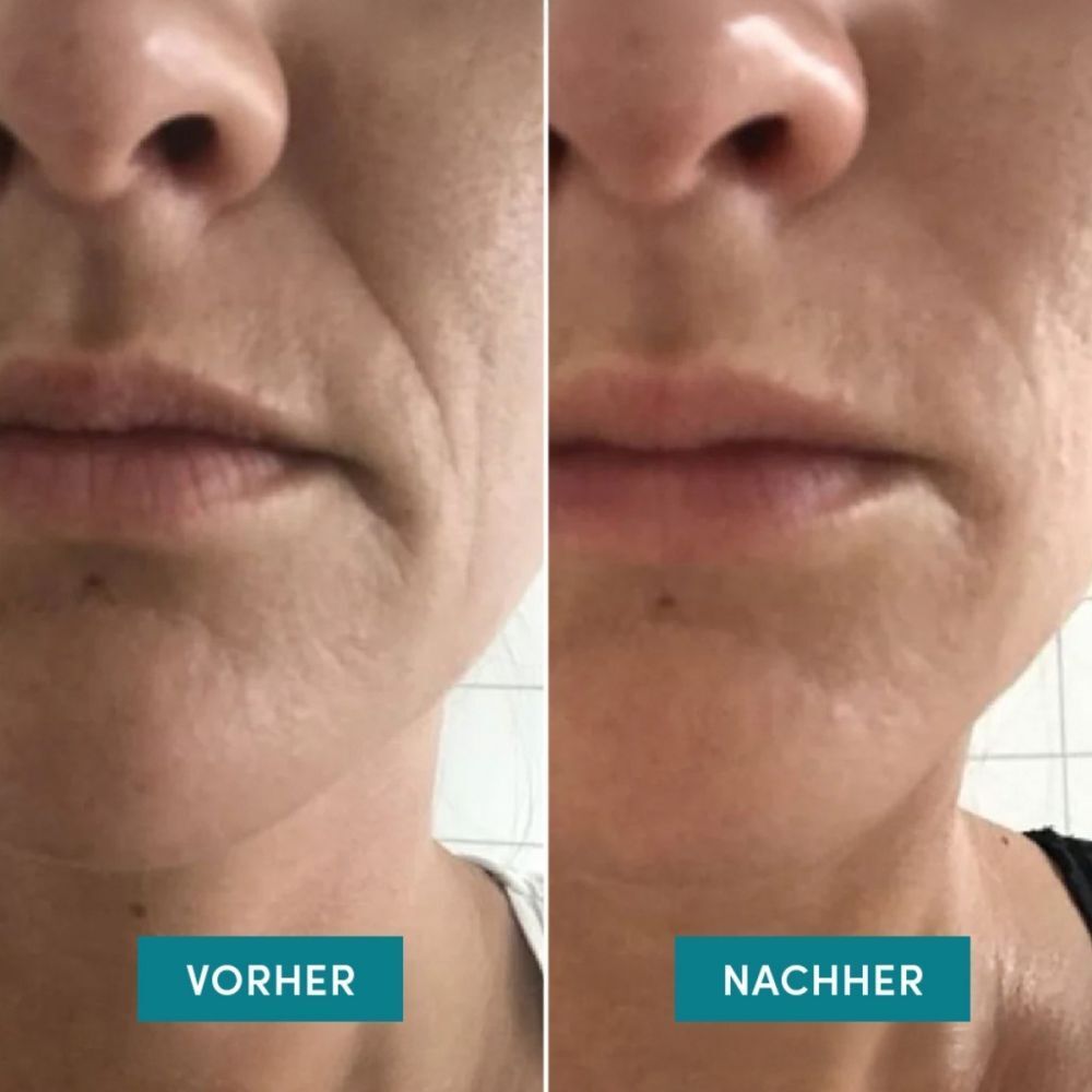 Comparaison avant-après de la peau autour de la bouche, ridée et lissée.