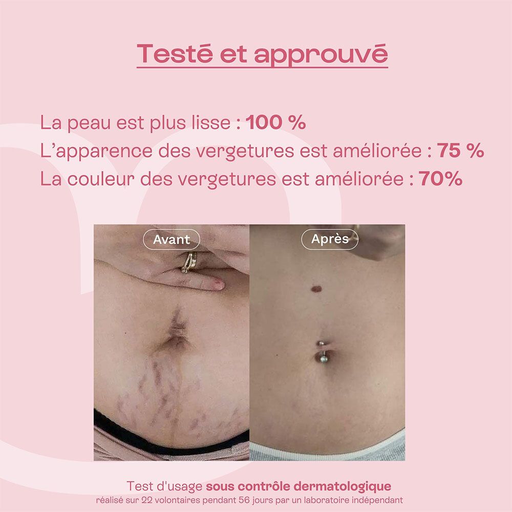 Comparaison avant/après vergetures. Peau plus lisse : 100%.