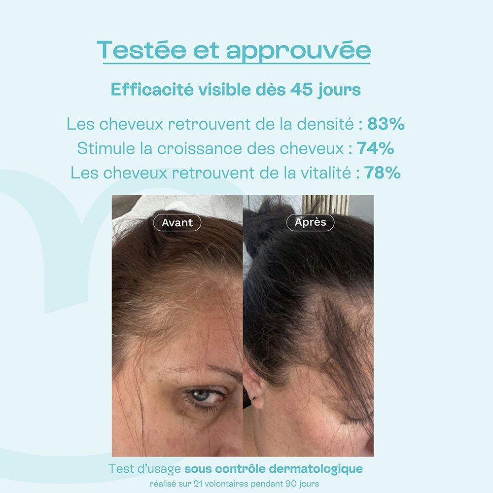 Comparaison avant-après de la densité capillaire après 45 jours d'utilisation OMUM.