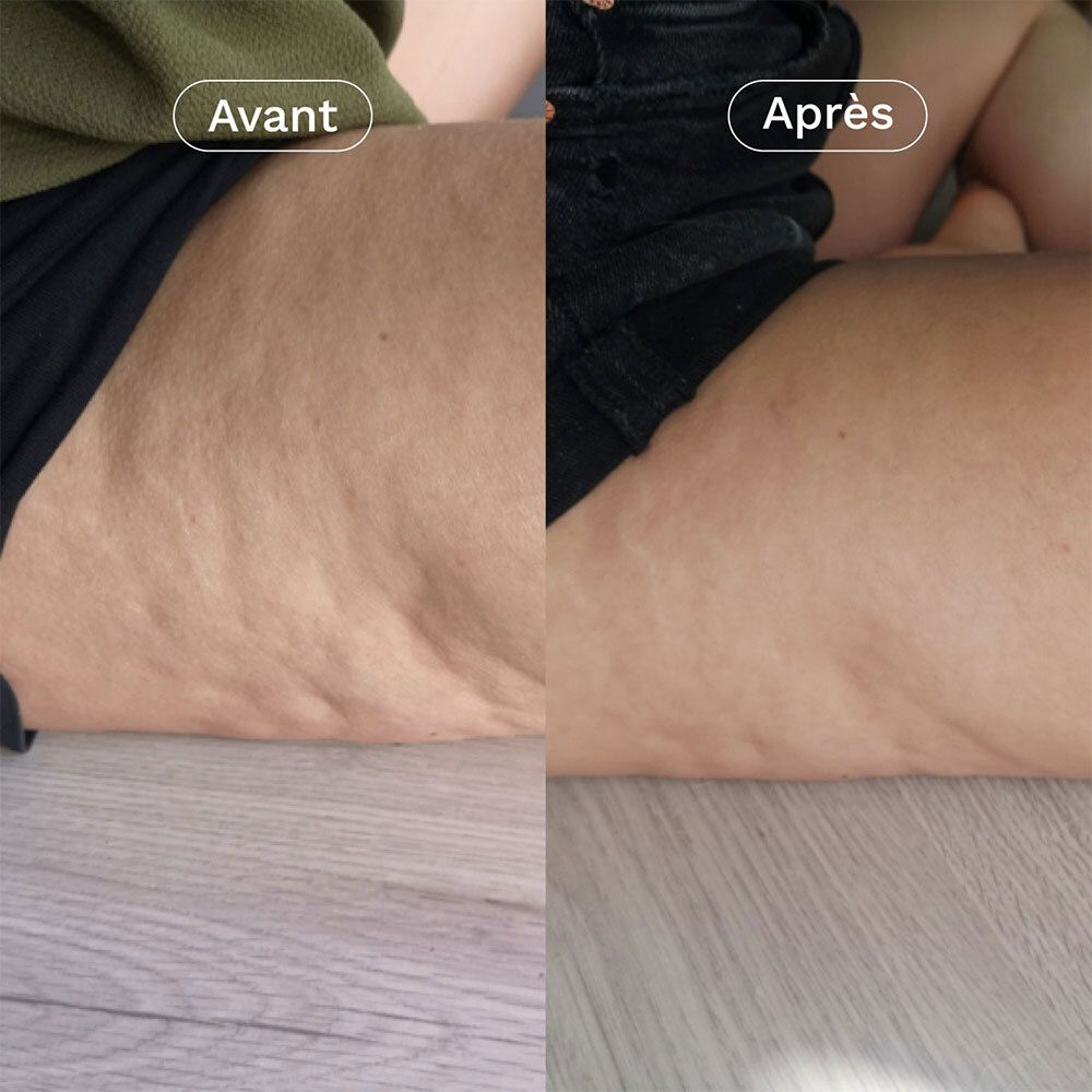 Comparaison avant-après de la cellulite sur les cuisses.