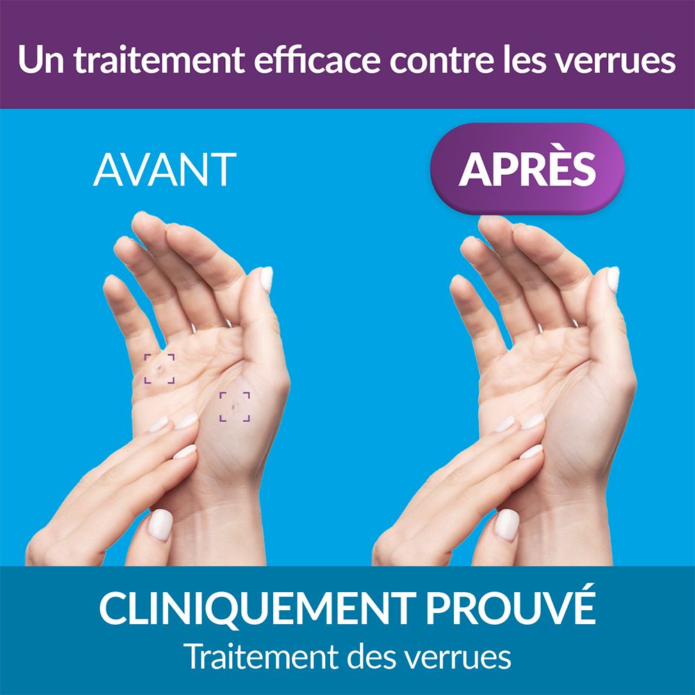 Excilor cryo verrue