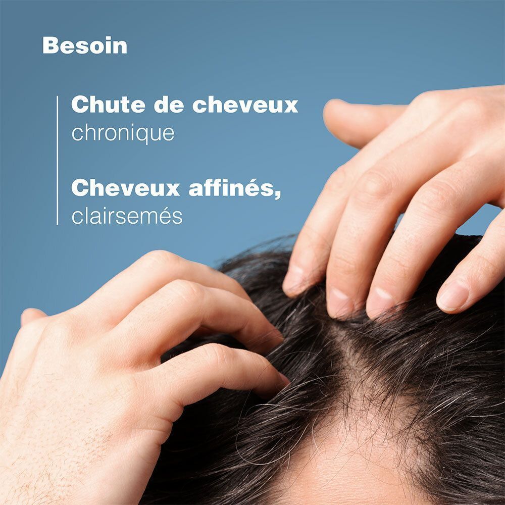 Mains sur le cuir chevelu. Texte: Besoin, Chute de cheveux chronique, Cheveux affinés, clairsemés.