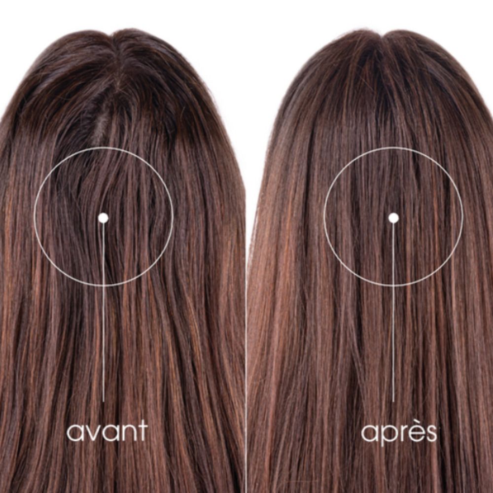 Deux vues de cheveux. À gauche: avant. À droite: après. Cercles marquant le cuir chevelu.