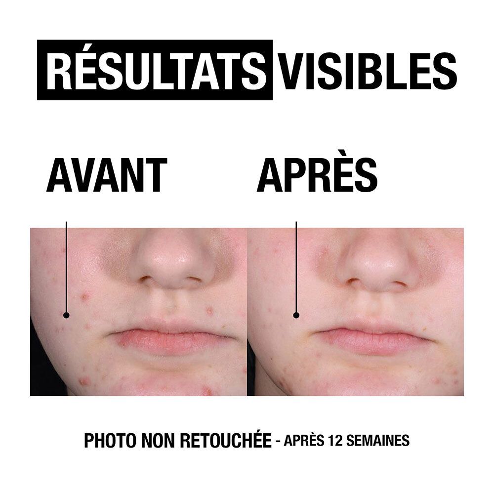 Neutrogena Anti-Boutons + Exfoliant Visage Peaux à Tendance Acnéique 125ml