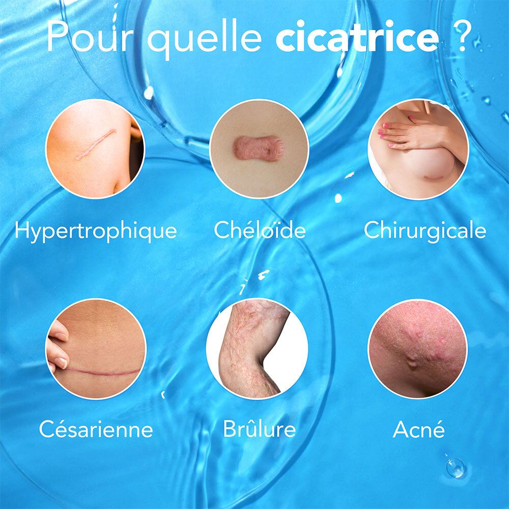 Types de cicatrices: hypertrophique, chéloïde, chirurgicale, césarienne, brûlure, acné.