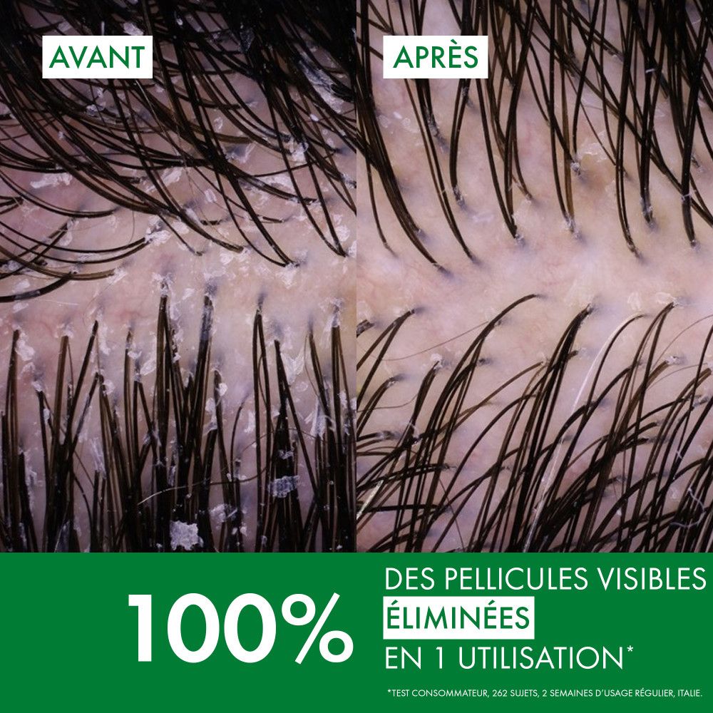 Vue microscopique du cuir chevelu. Avant et après. Texte: 100% des pellicules visibles éliminées en 1 utilisation.