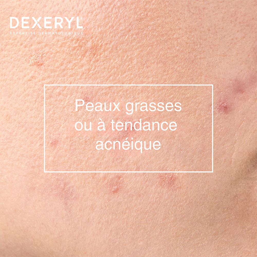 Gros plan sur la peau avec imperfections. Texte : Peaux grasses ou à tendance acnéique.