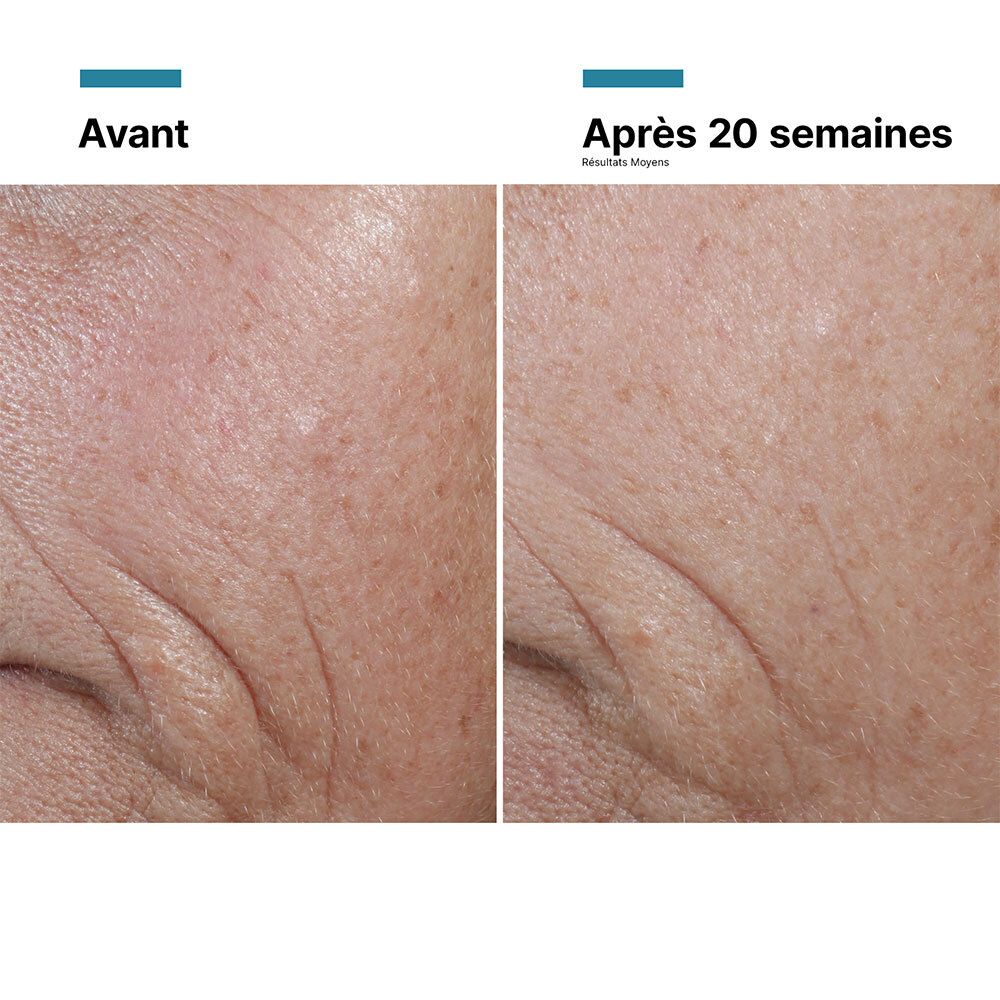 Comparaison avant-après. Peau ridée avant et après 20 semaines de traitement.