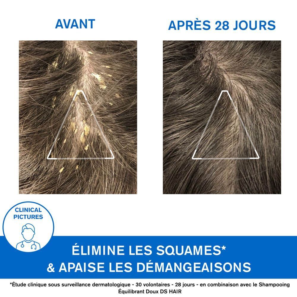 Images avant-après du cuir chevelu. Texte: Élimine les squames & apaise les démangeaisons.