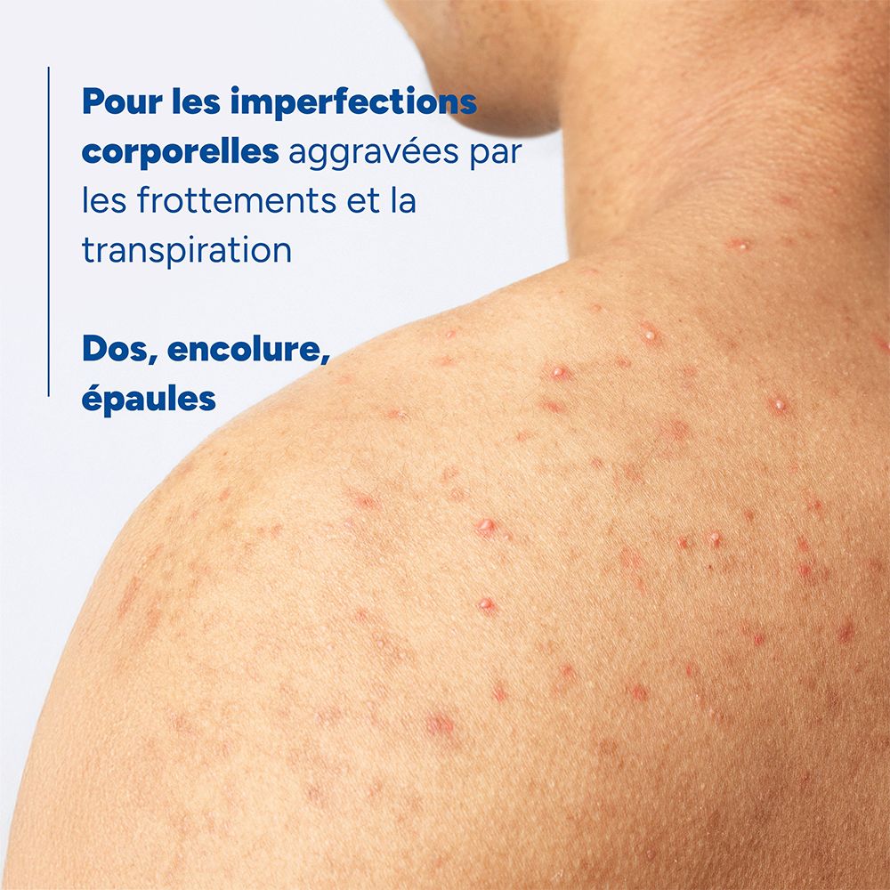 Peau avec imperfections sur le dos et la nuque. Pour les imperfections corporelles.