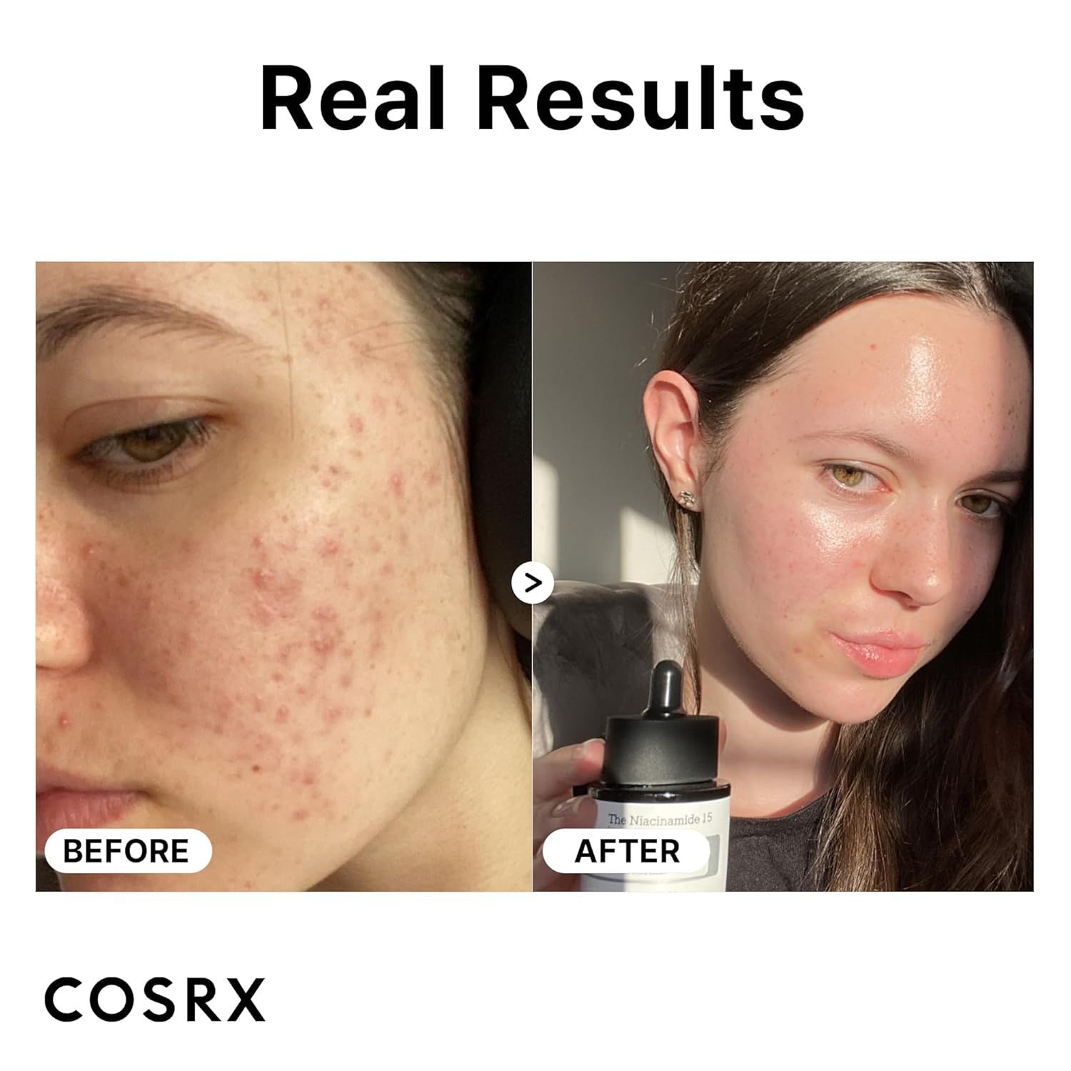 Comparaison avant-après de peau acnéique et peau améliorée après utilisation du sérum COSRX.